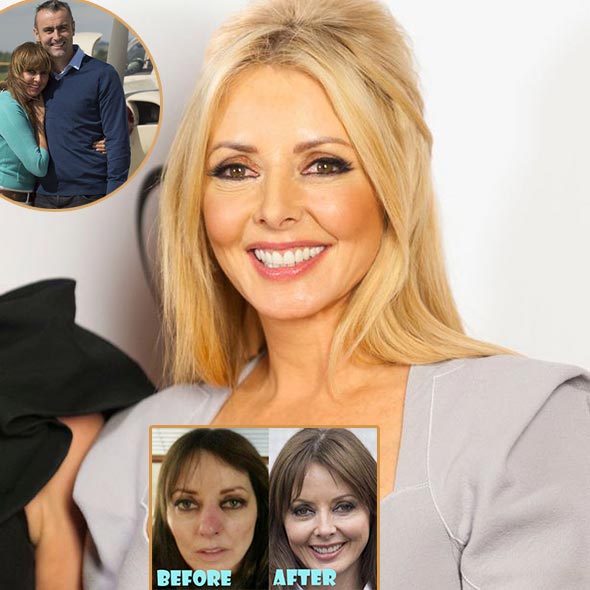 Twice-Divorced Carol Vorderman, On Age Gap With Ex-Partner: Happy For Having Plastic Surgery