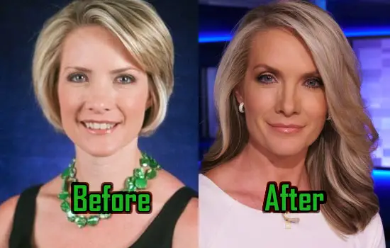 Dana Perino's before and after plastic surgery picture comparision