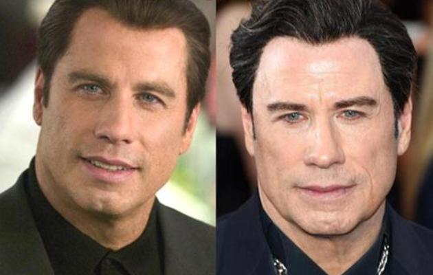 John Travolta Plastic Surgery Before and After