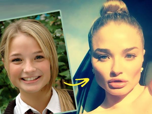 Caption: Emma Rigby before and after plastic surgery. 
