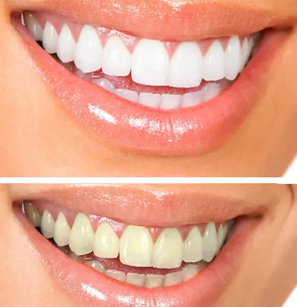 Here's How To Get White Teeth From 1 Day To A Week-Both Fast And Naturally