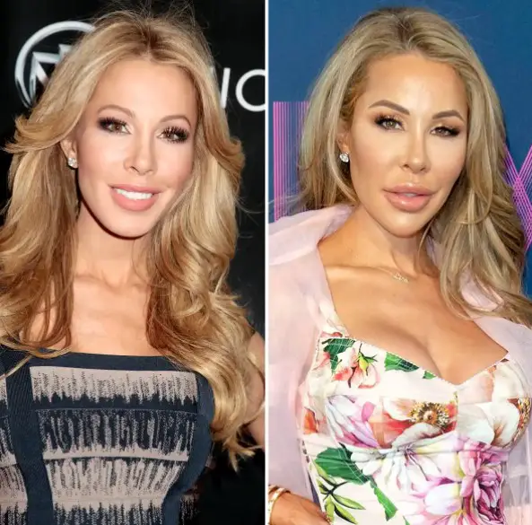 Before and After of Lisa Hochstein's Surgery